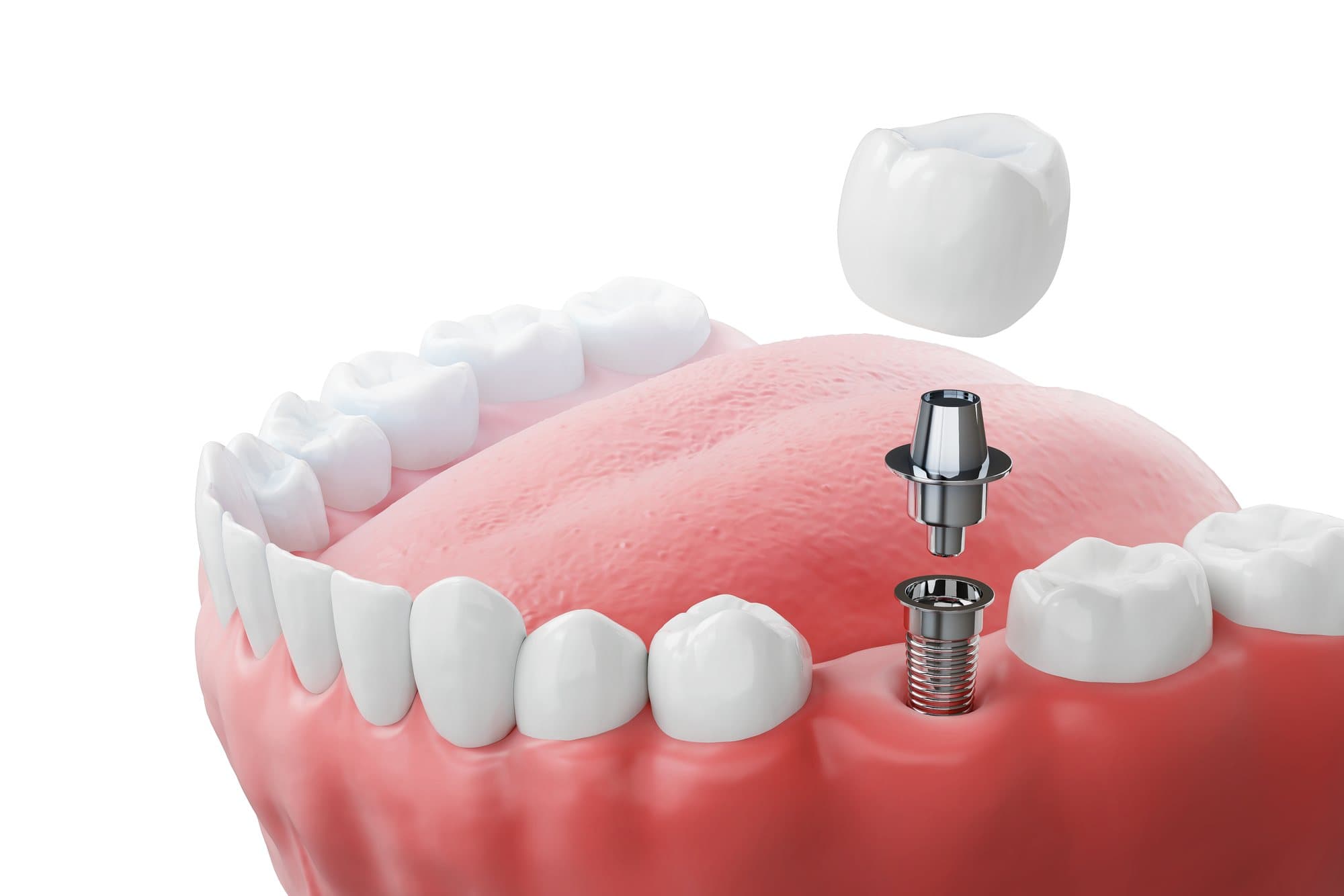 An illustration showing the three parts of a dental implant: the post, the abutment and the crown
